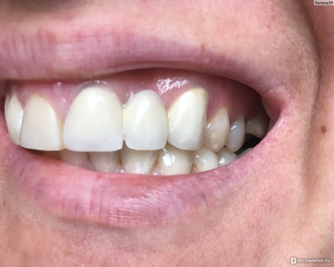 Диоксид Циркония На Передние Зубы Фото