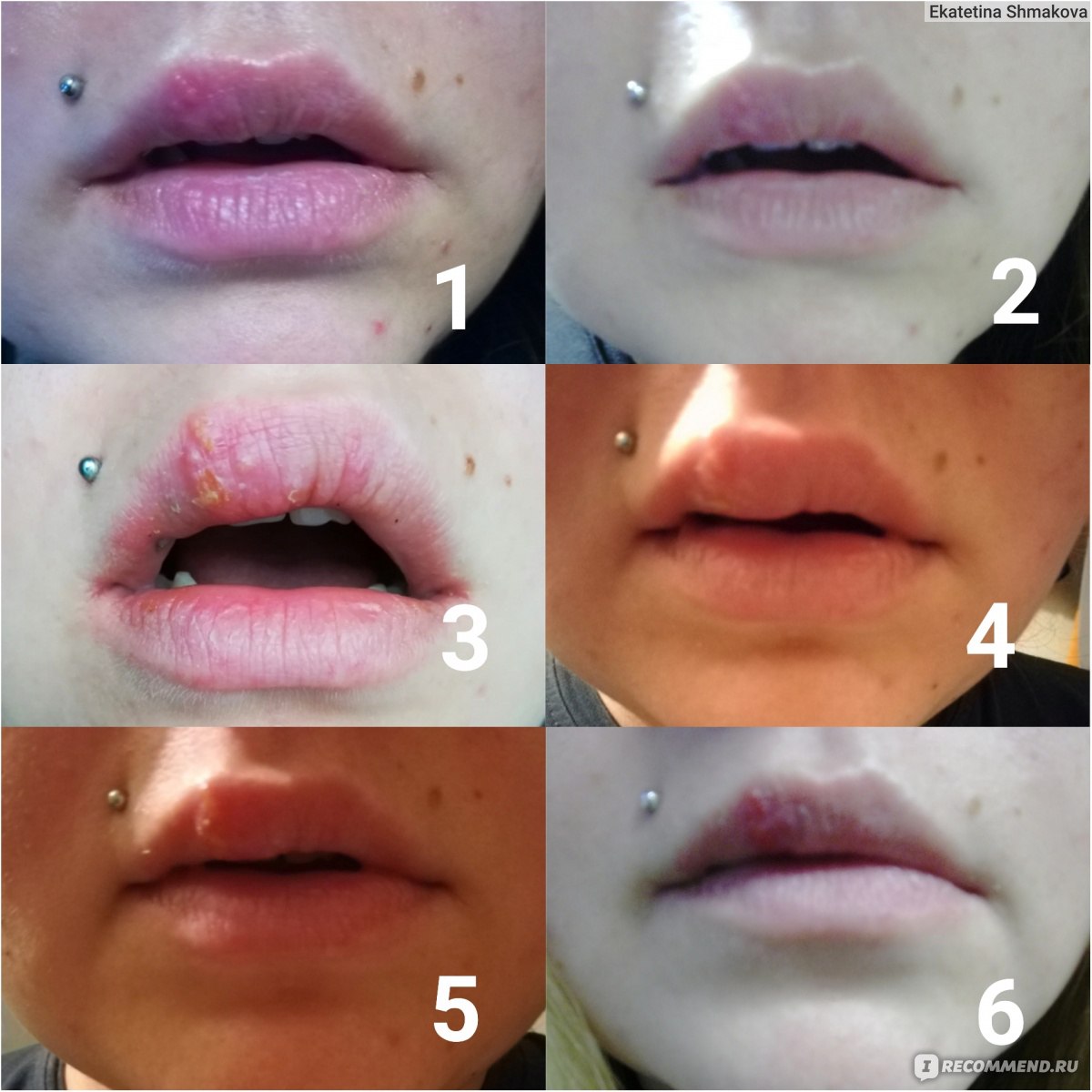 Этапы заживления простуды на губах