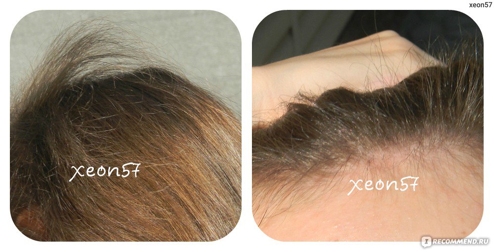 Восстановление выпадения волос