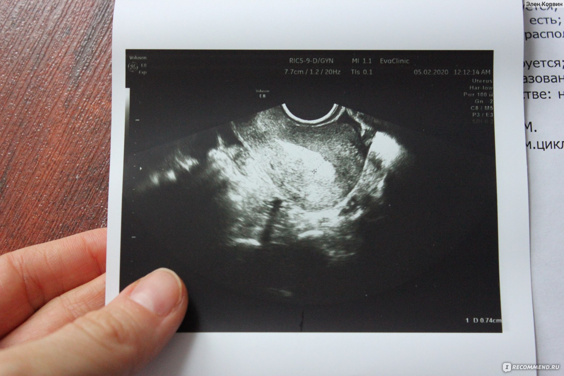 Когда на узи видно беременность на ранних. Трансвагинальное УЗИ снимок. Монитор УЗИ. Трансвагинальное УЗИ на ранних сроках беременности.