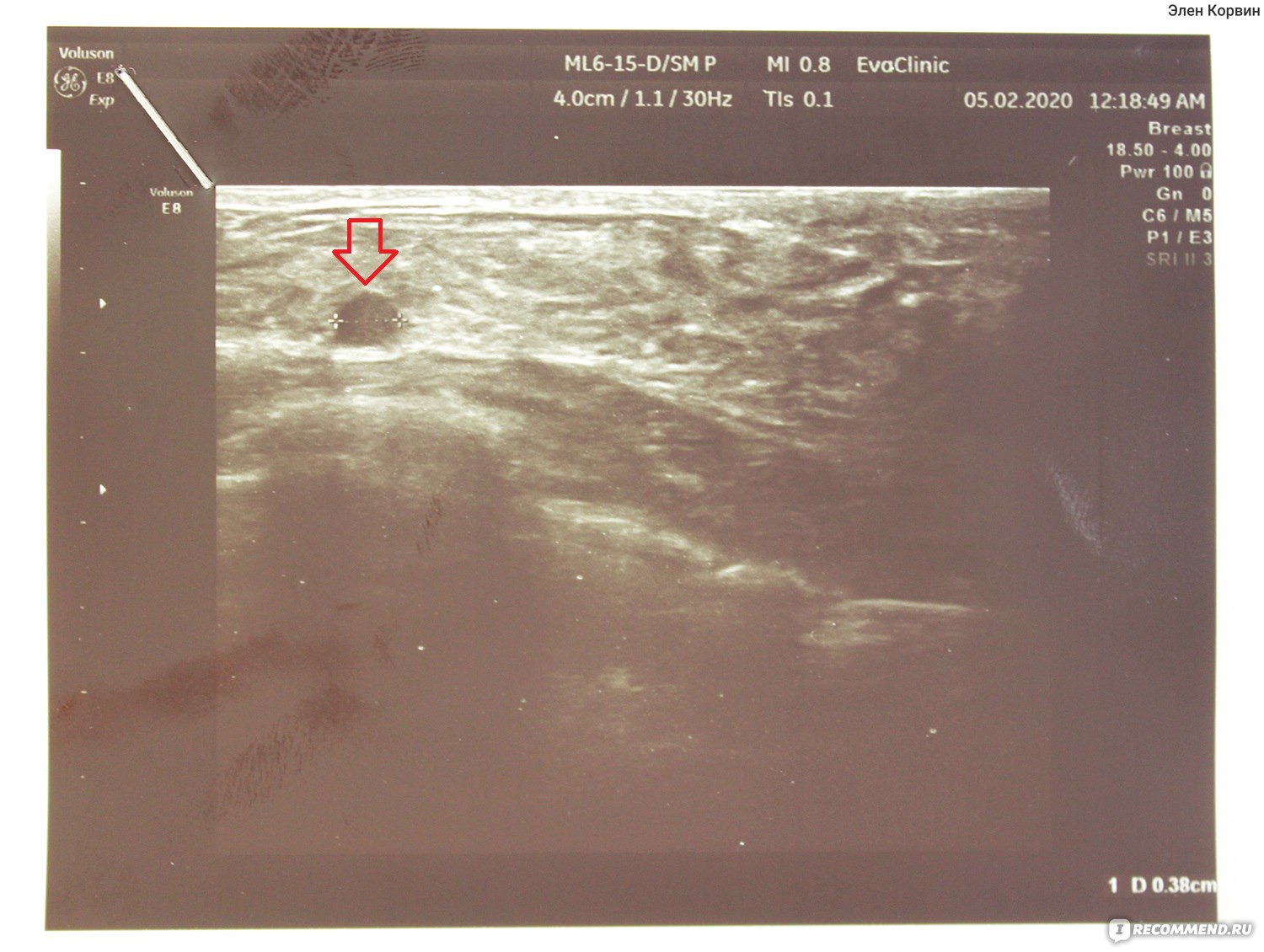 фиброаденома в груди при беременности фото 103