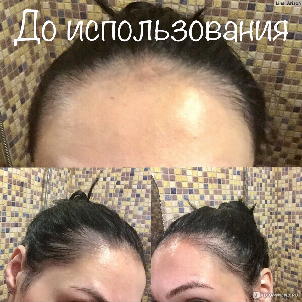 Средство от выпадения волос Vichy Dercos aminexil intensive 5 для женщин фото