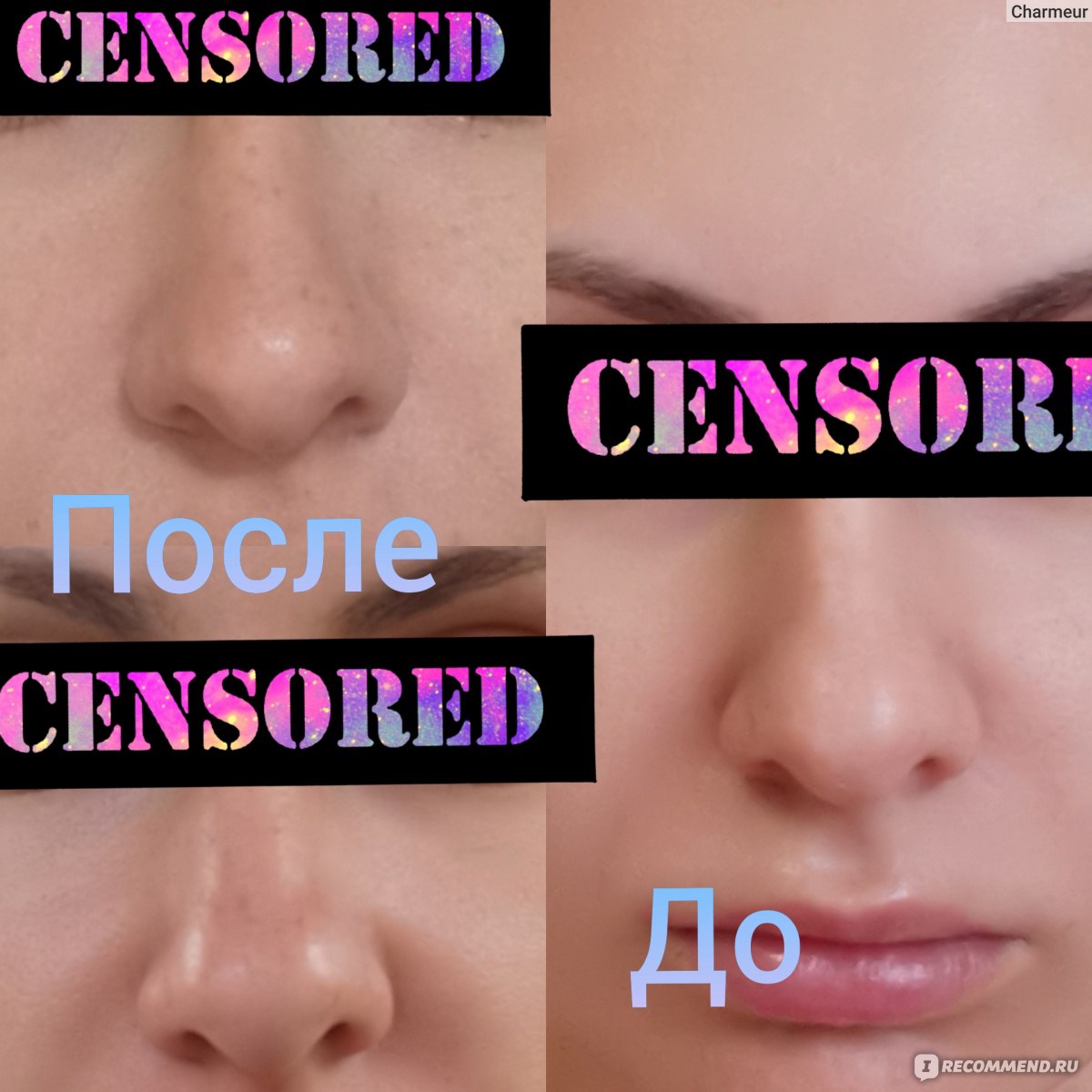 Дипроспан в нос для уменьшения носа