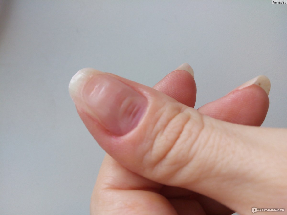 Из-за чего ногти становятся ребристыми и что делать в этом случае