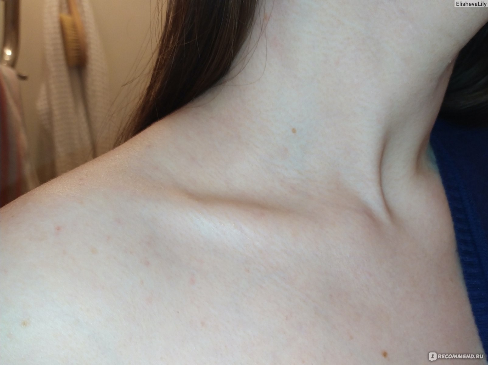 сыпь на шее на груди у женщин фото 113