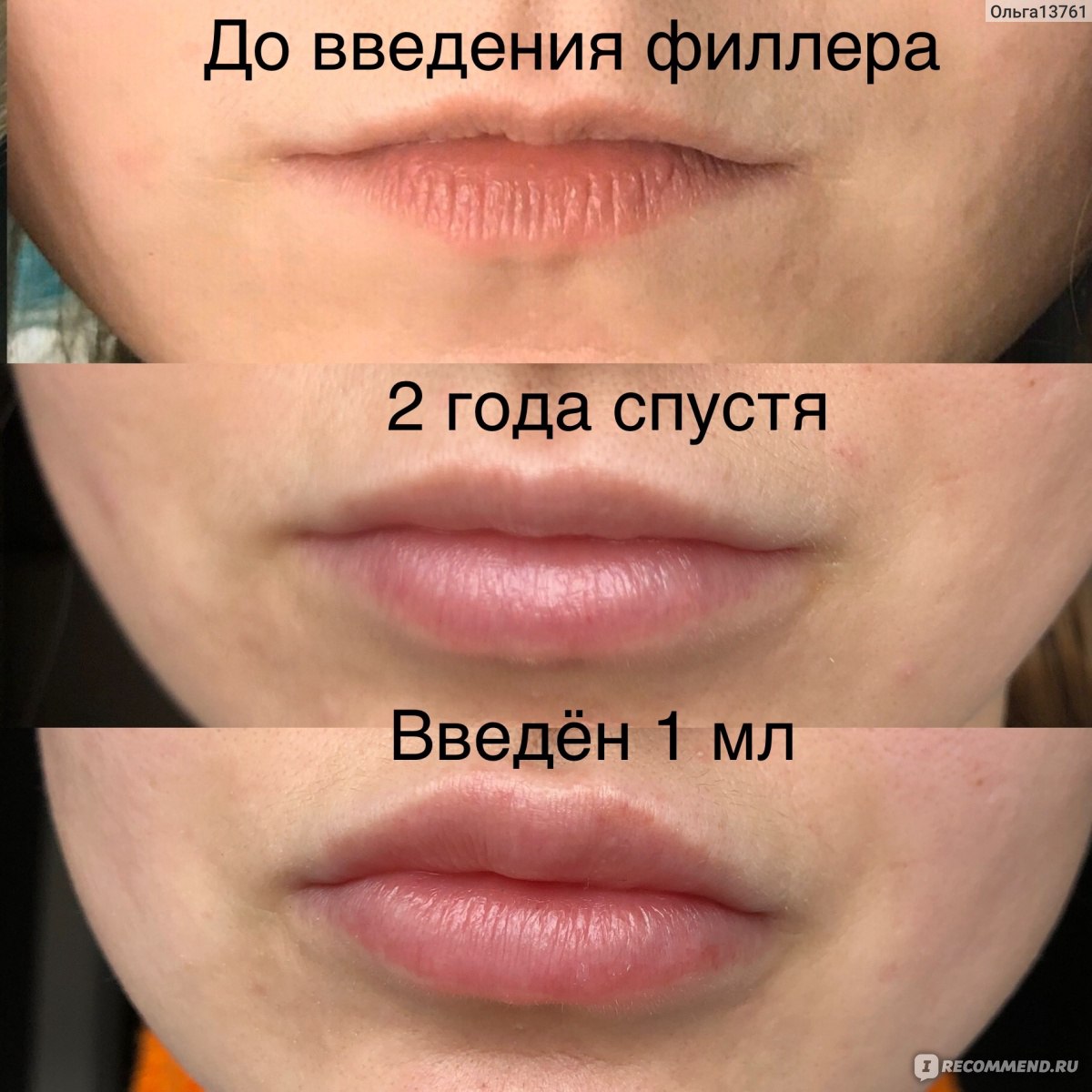 уменьшение малых губ фото до и после
