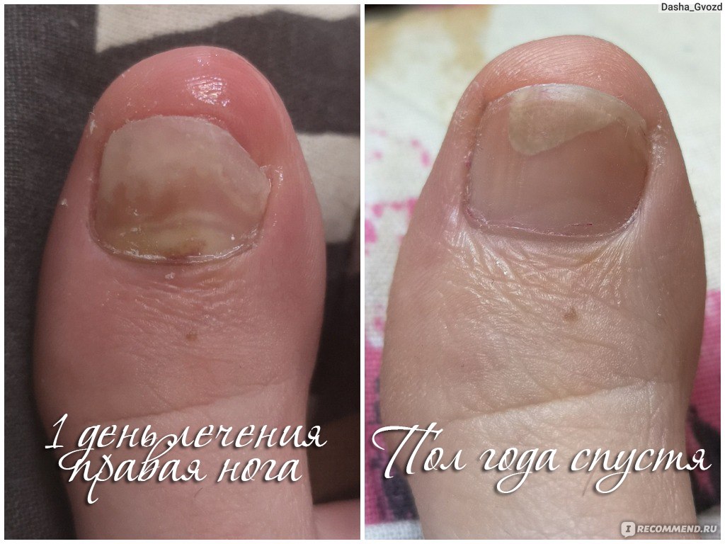 Лечение грибка ногтей в домашних условиях