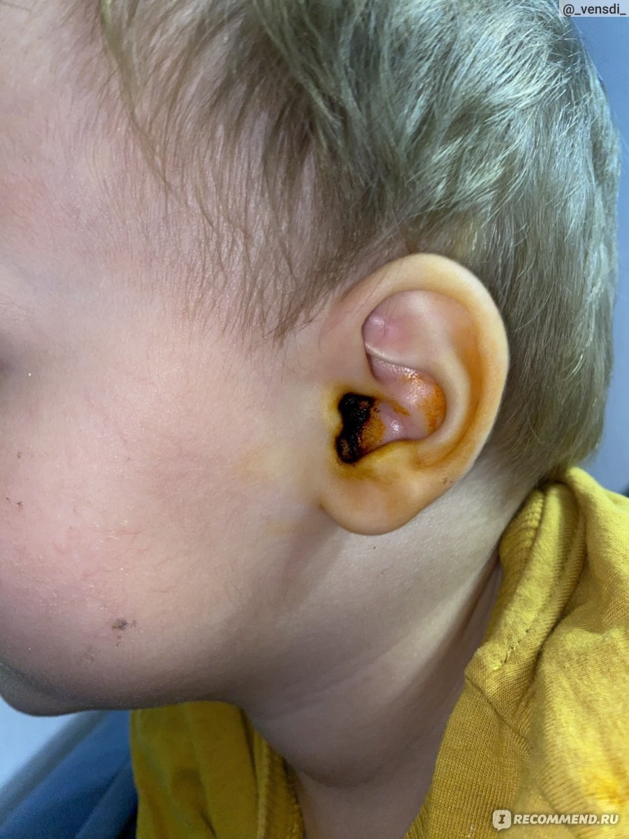 Выделения из уха: причины и лечение | Клиника Рассвет