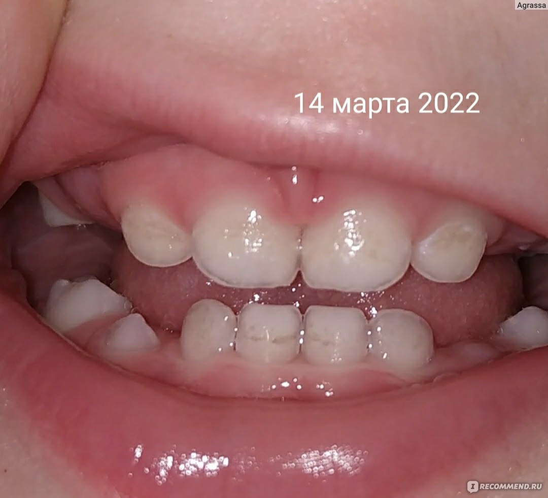 Гипоплазия молочных зубов: что такое и причины появления