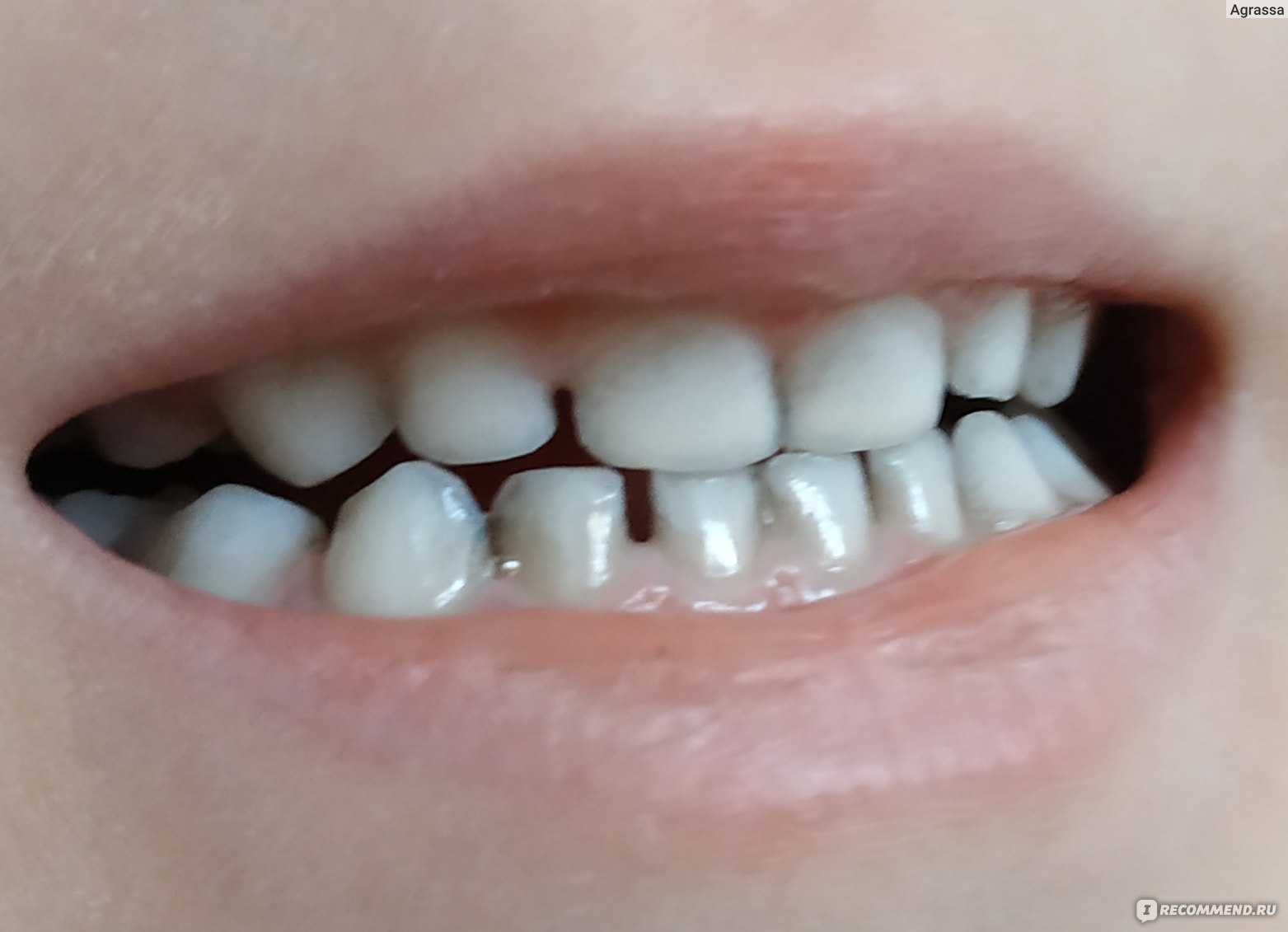 железо, потемнели зубы у ребёнка