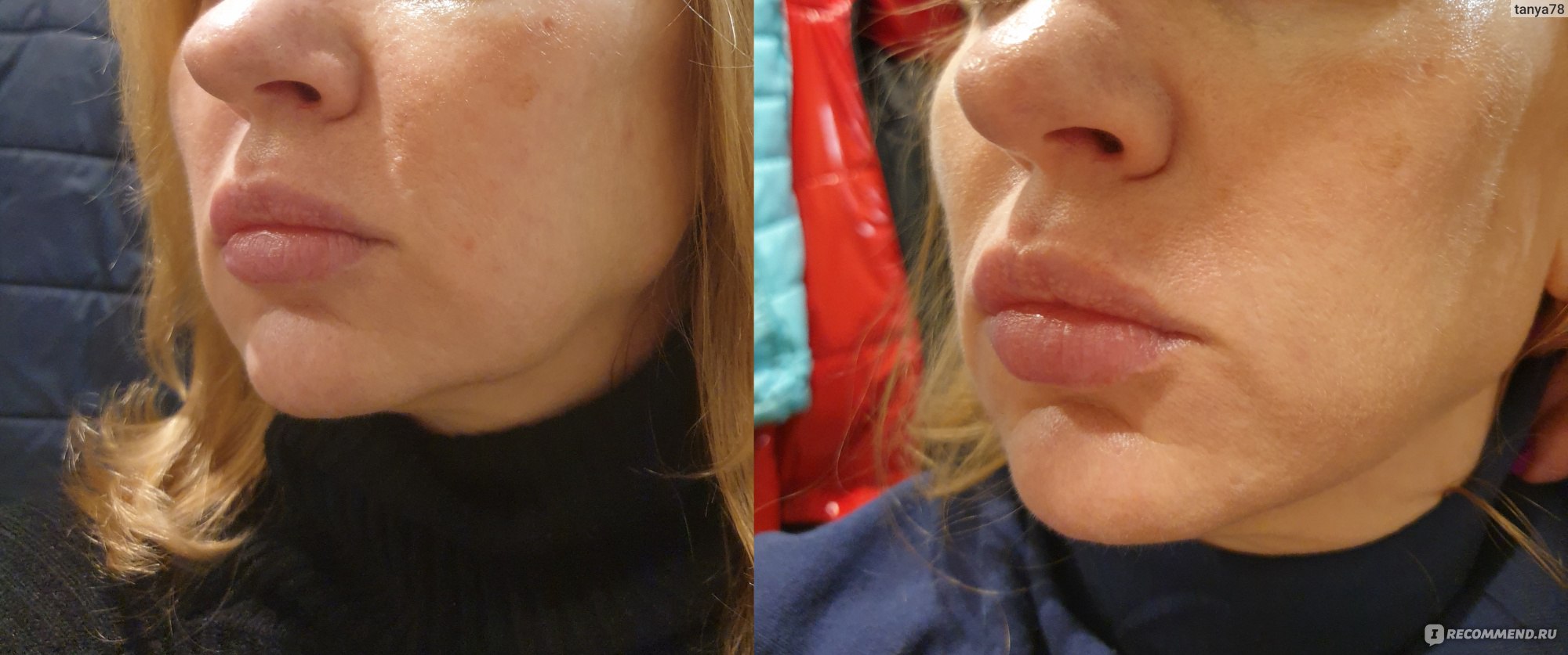 Брыли на лице фото до и после липолитики для лица щеки