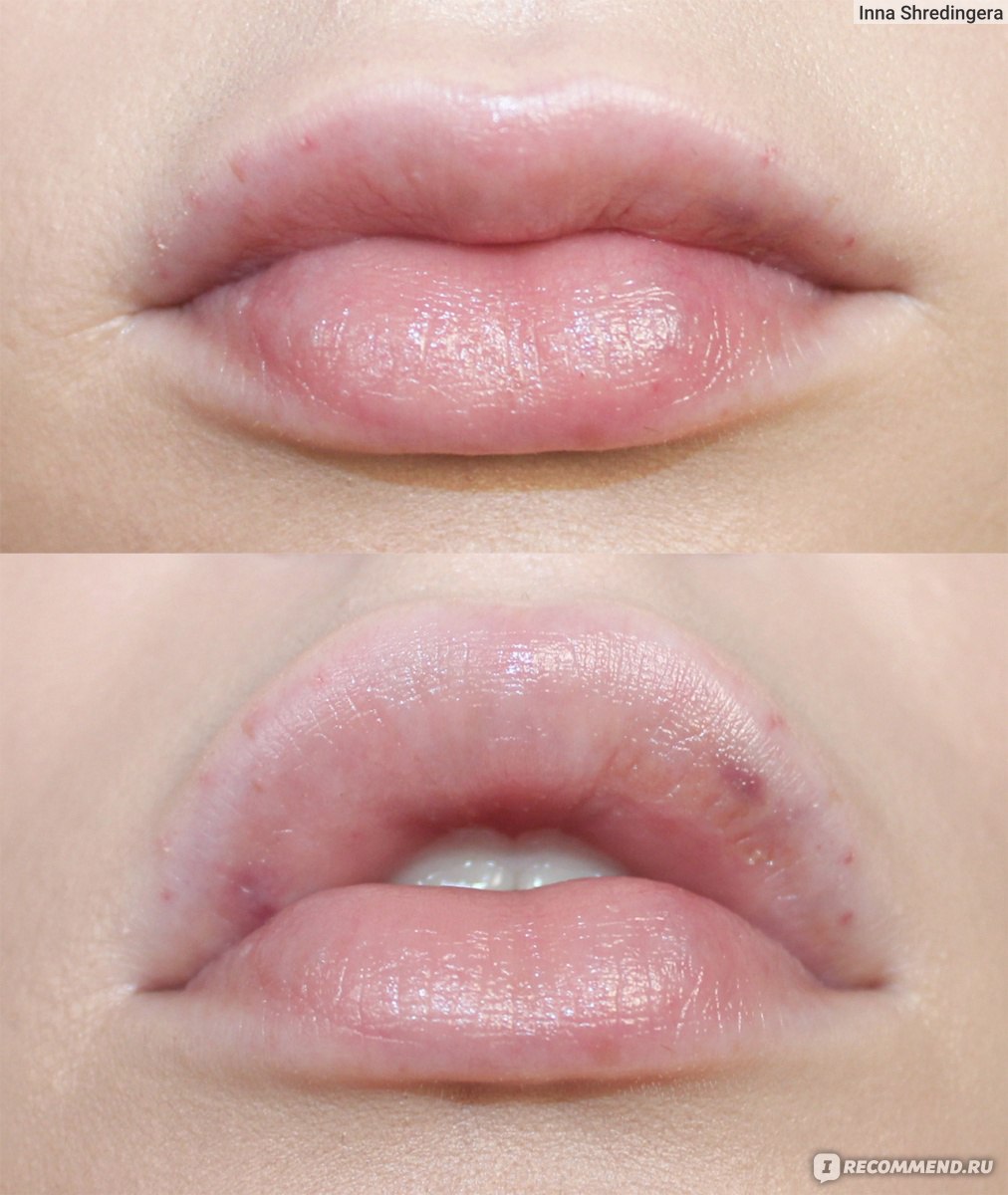 Асимметрия губ после увеличения
