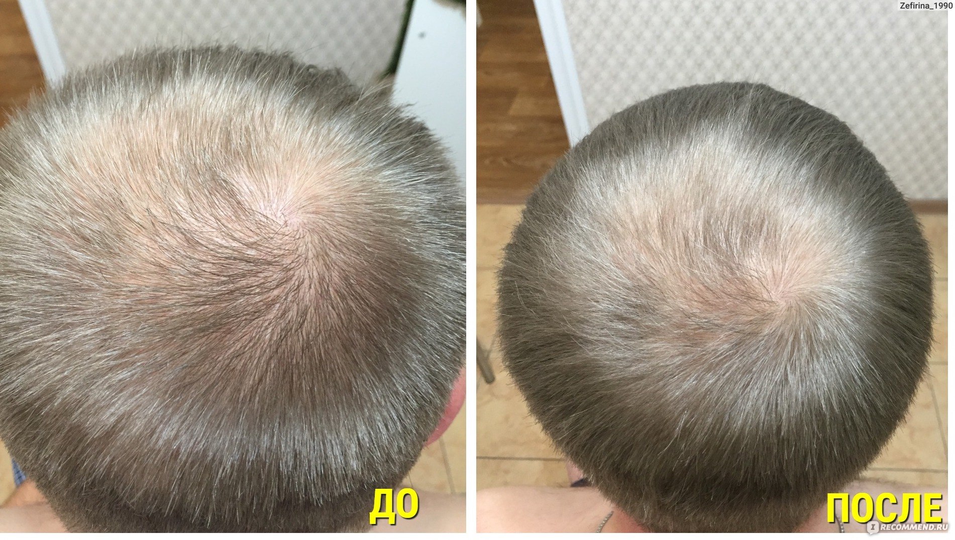 Сыворотка для волос Matrigen Mesotox Scalp Solution фото