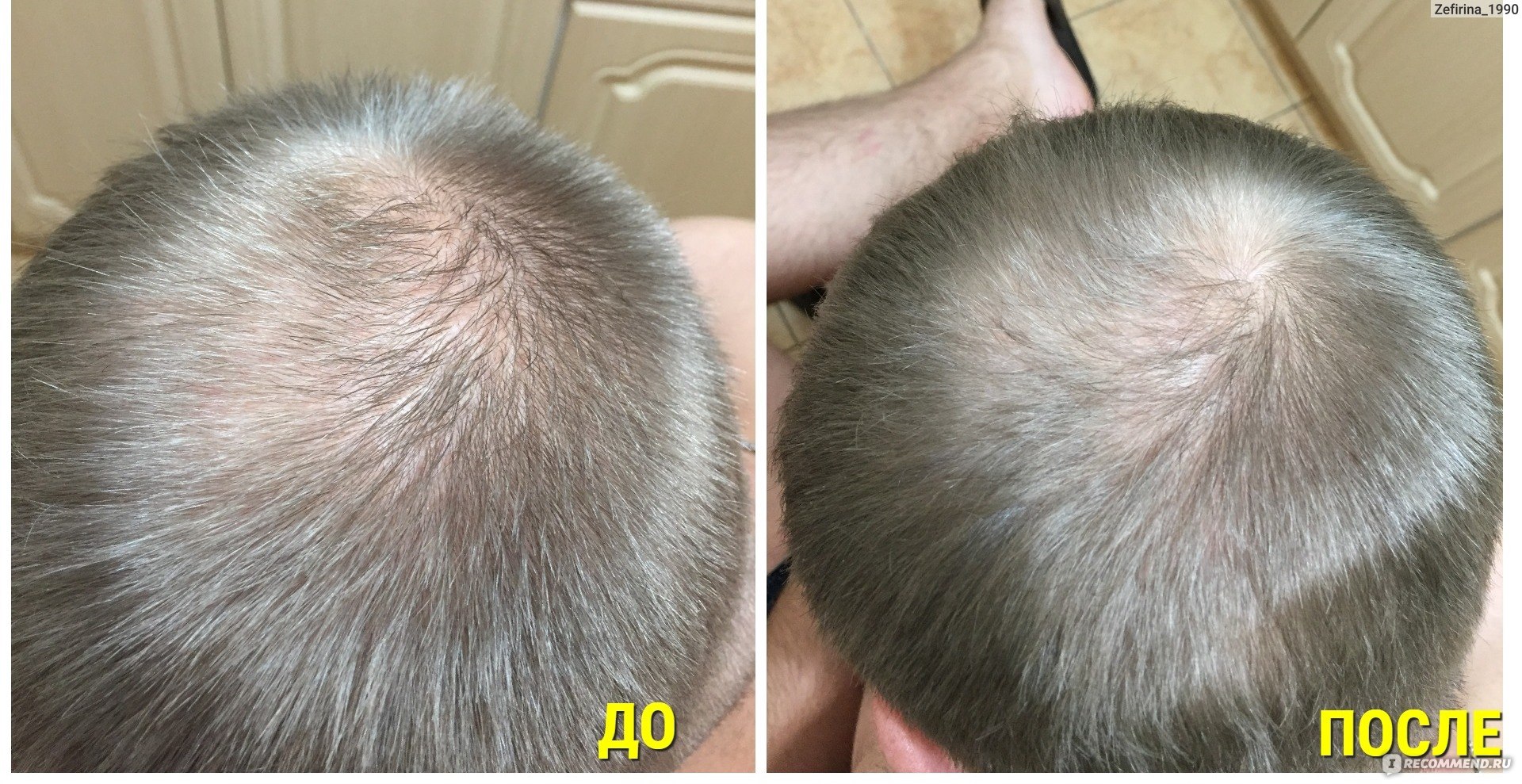 Сыворотка для волос Matrigen Mesotox Scalp Solution фото