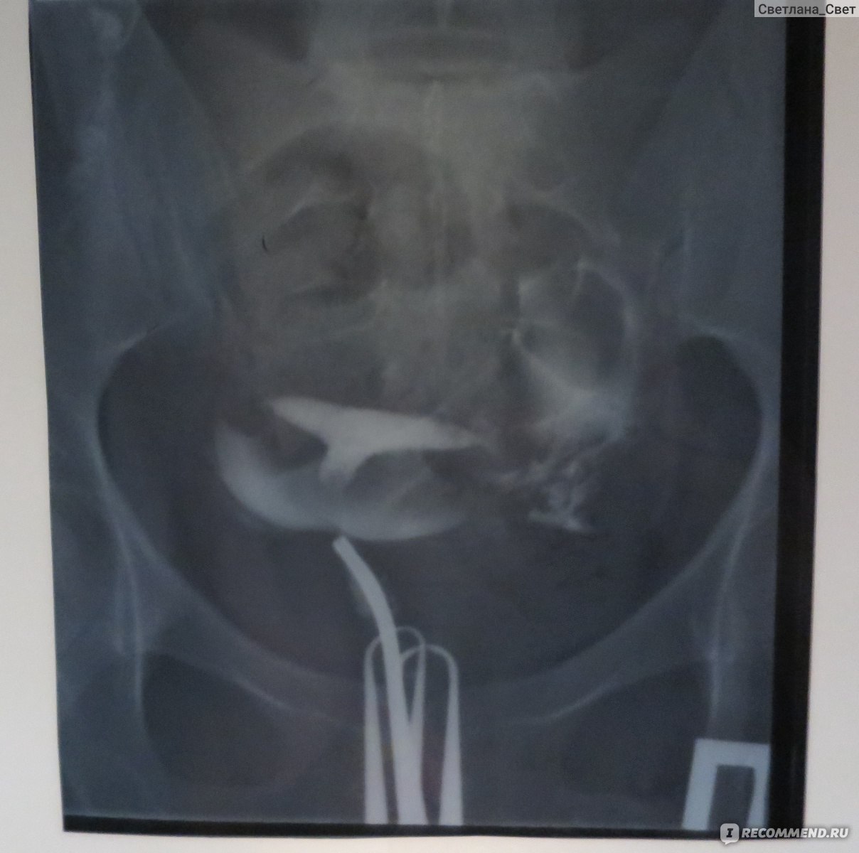 Рентген маточных труб лапароскопия