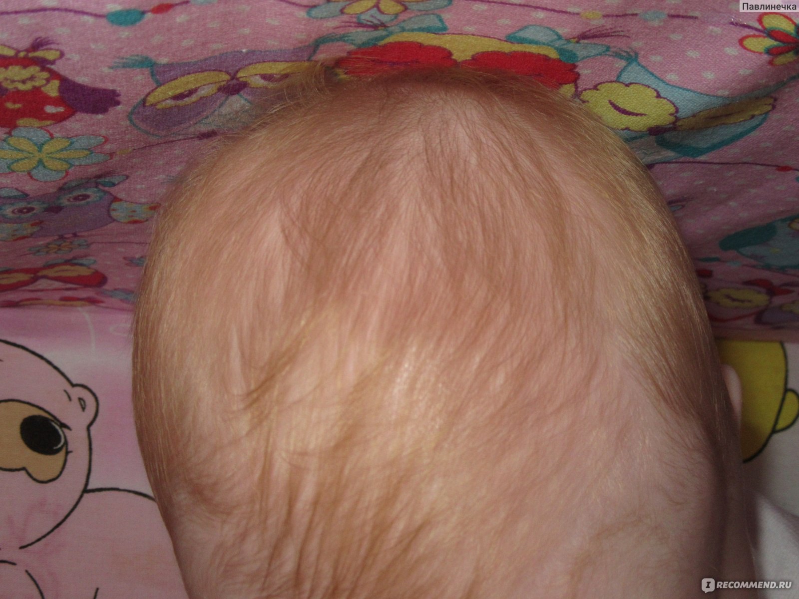 Корочки на голове у ребенка до года