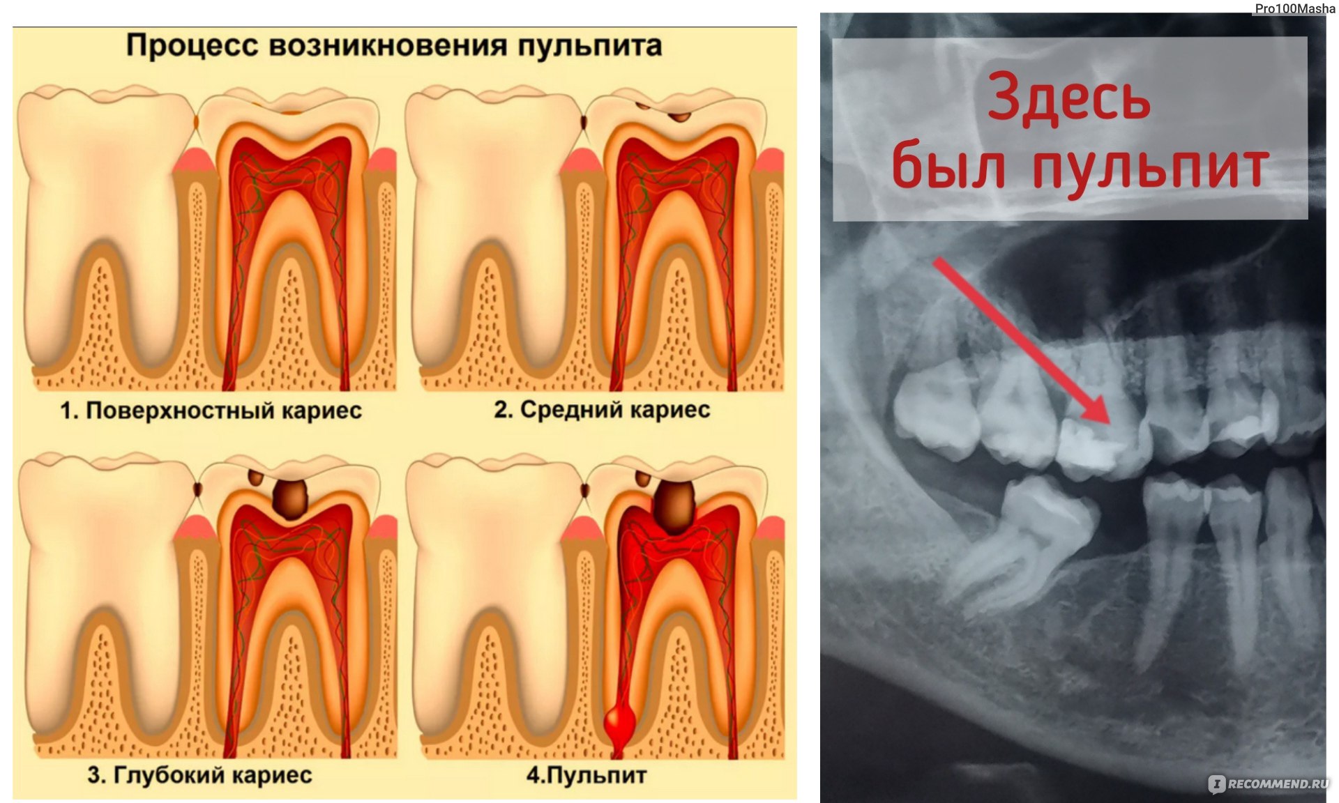 Признаки лечения зубов. Пульпит 2 канального зуба. 4 Канальный пульпит зуба.