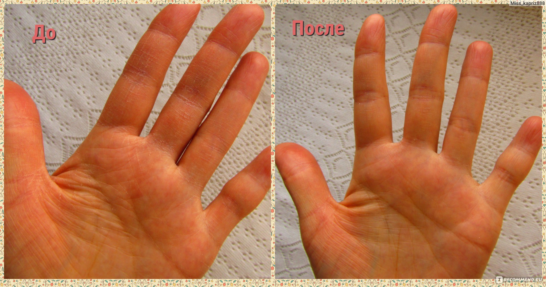 Восстановление кожи рук