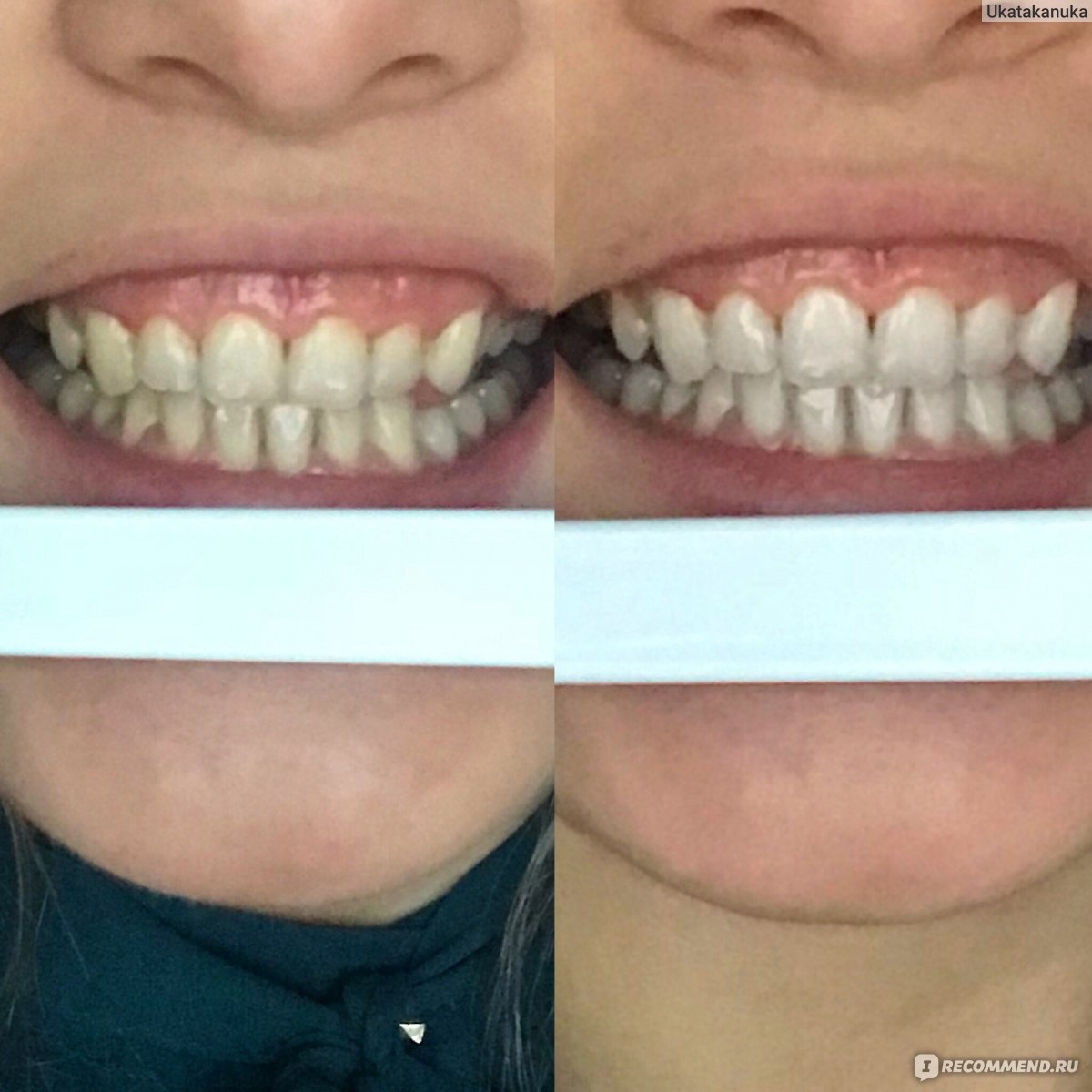 отбеливание зубов капы до и после
