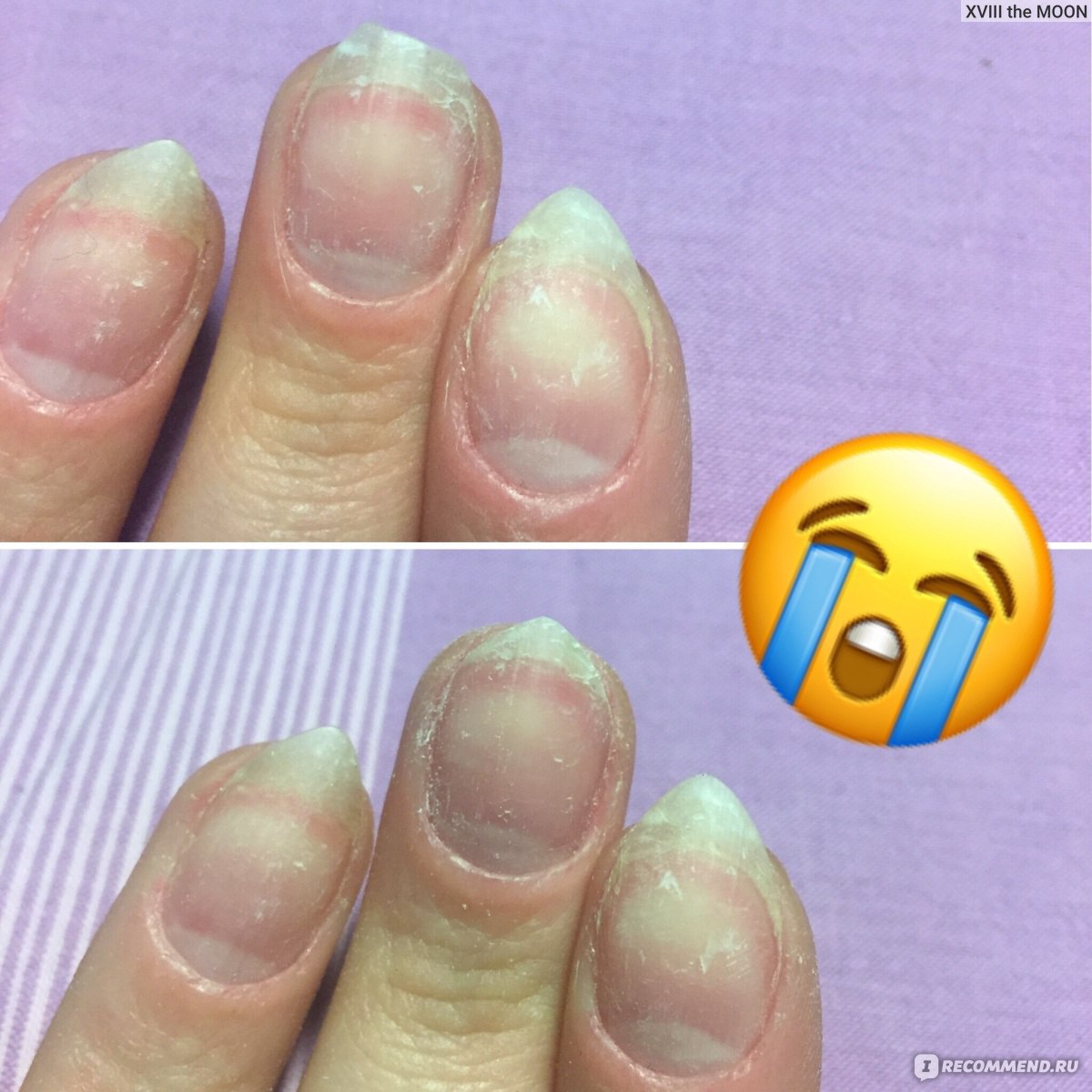 Как выглядят ногти после снятия гель лака фото