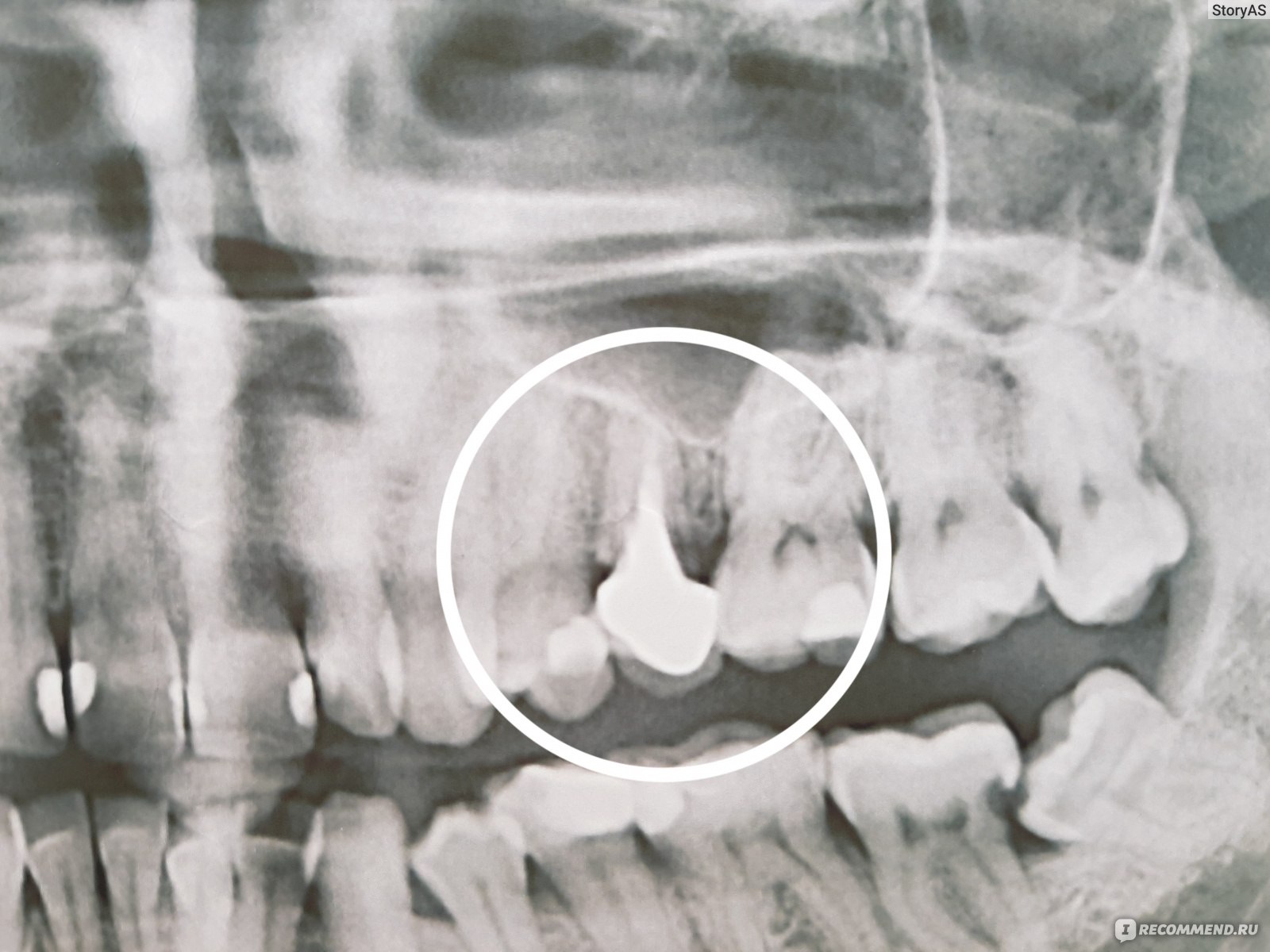 Ортопантомограмма зубов Ярославль