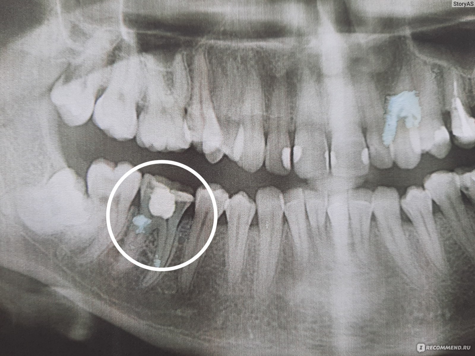 Снимок зуба Томск Мира стоматология дента томск фрунзе