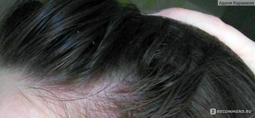 Волосы ДО лечения