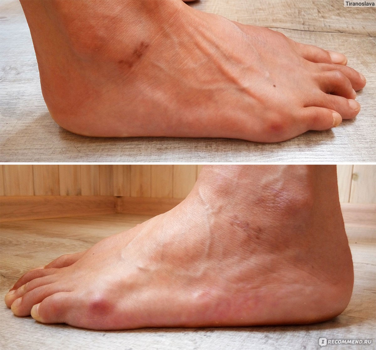 Hallux Valgus / Вальгусная деформация первого пальца стопы - «Как я  избавилась от hallux valgus и узнала, что существует лечение плоскостопия.  Очень подробный рассказ с фото и рентгенами (спустя: 4 мес, 8