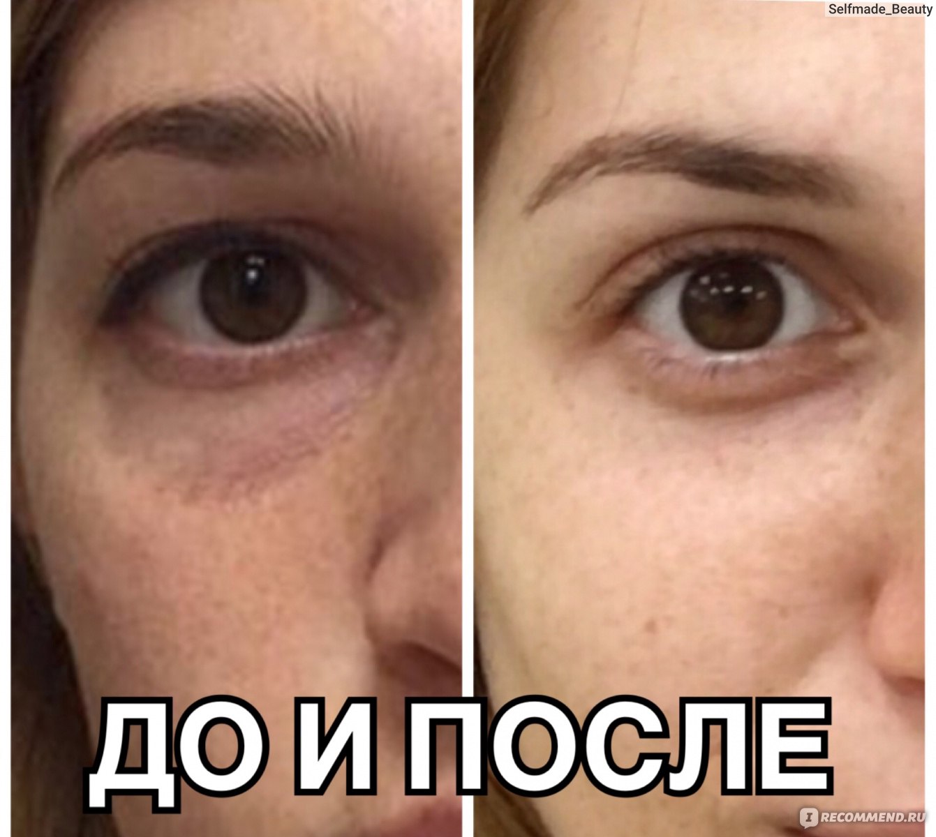 Заполнение носослезка до и после фото