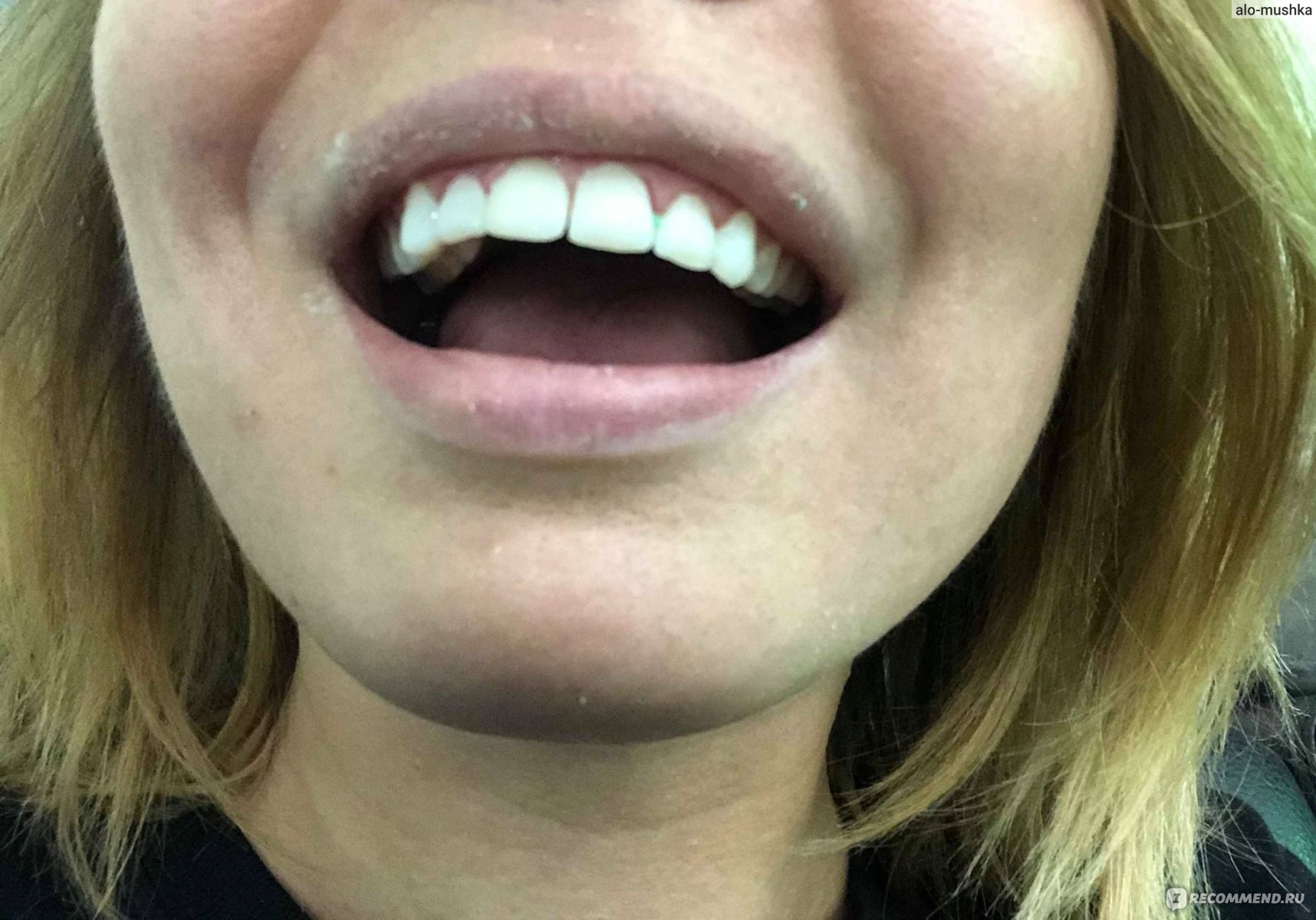 Подрезание десны между передними зубами
