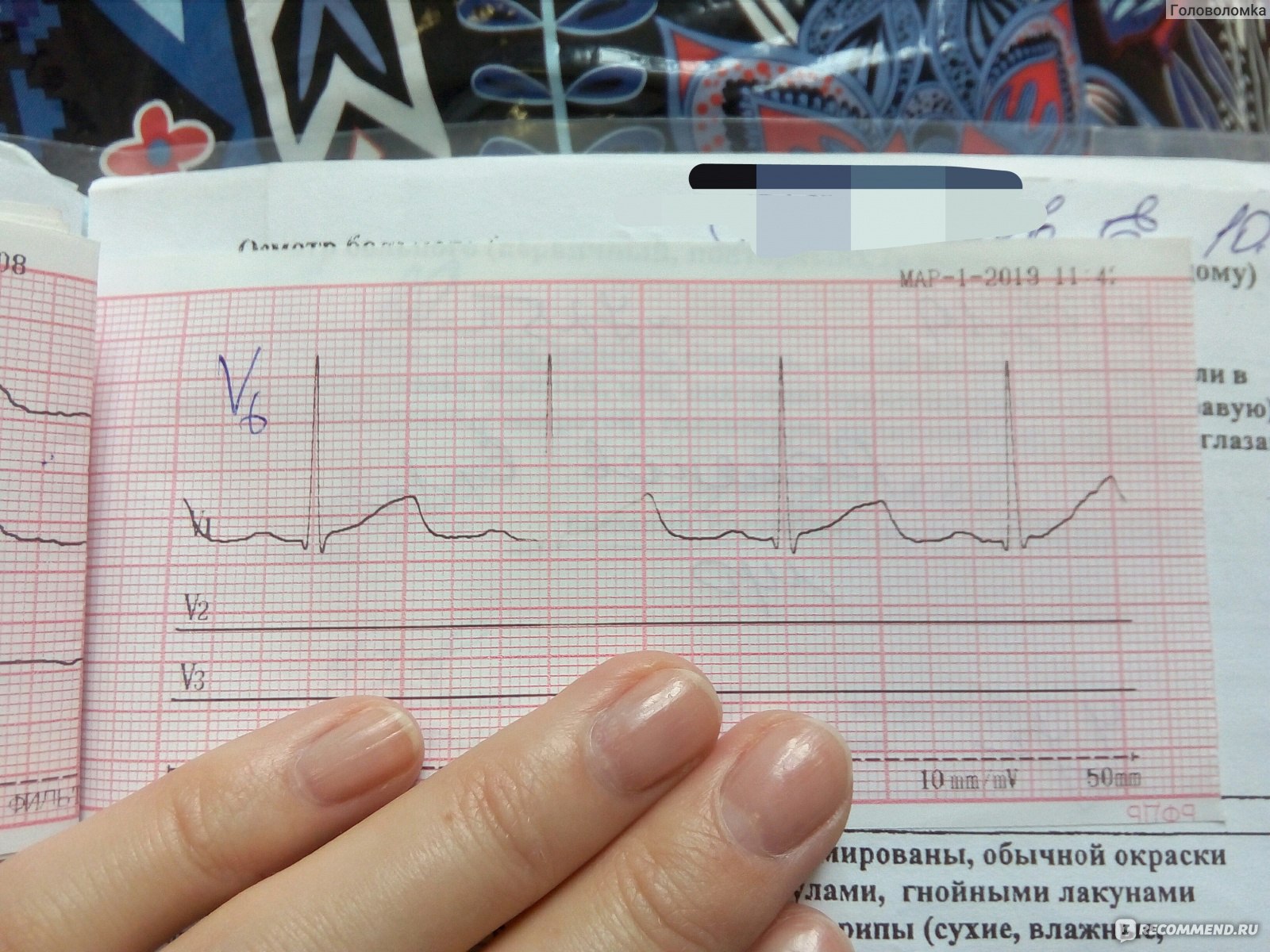 ЭКГ при открытом Овальном окне