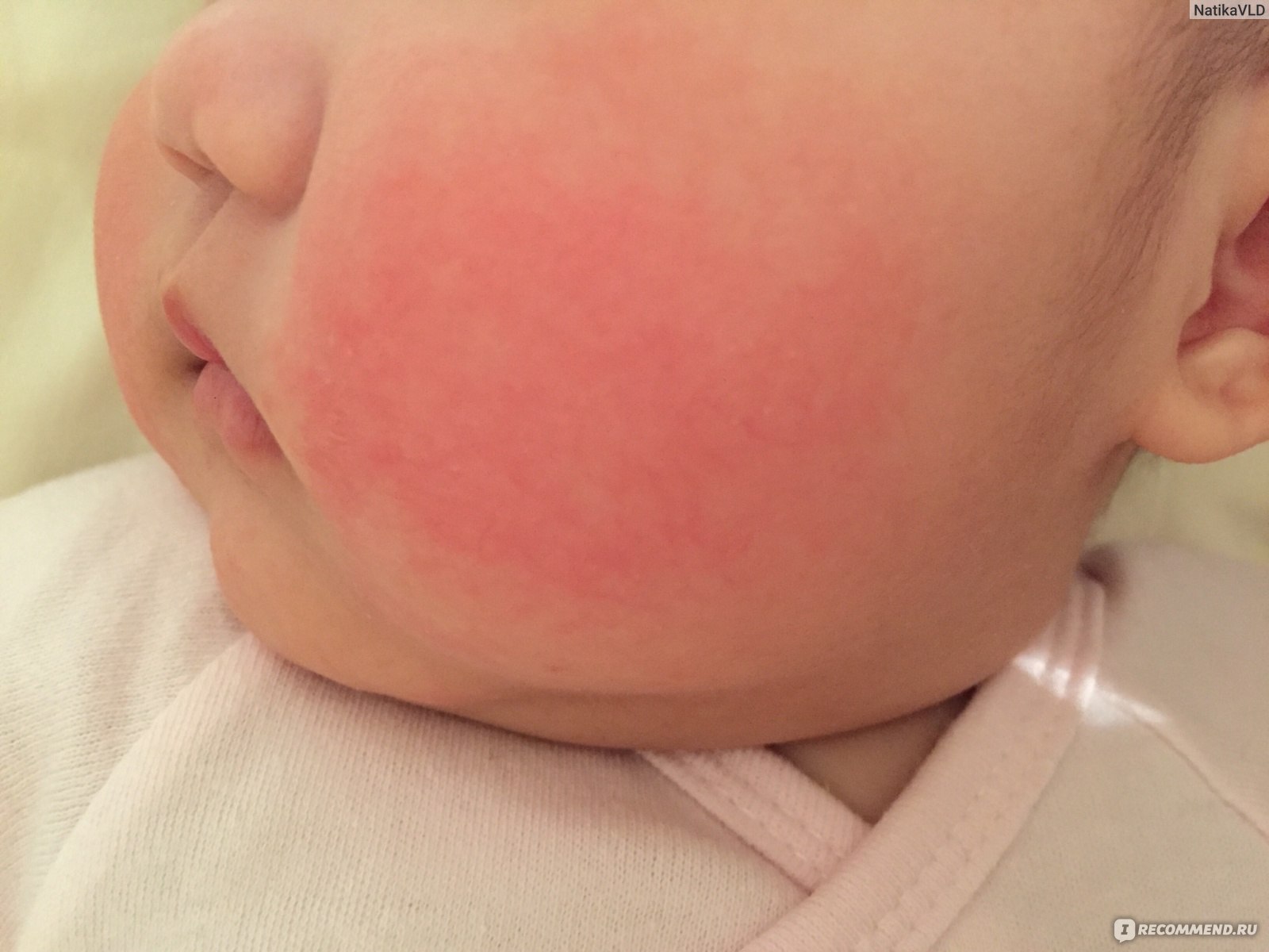 Аллергия на детскую смесь: как ее определить и что делать?
