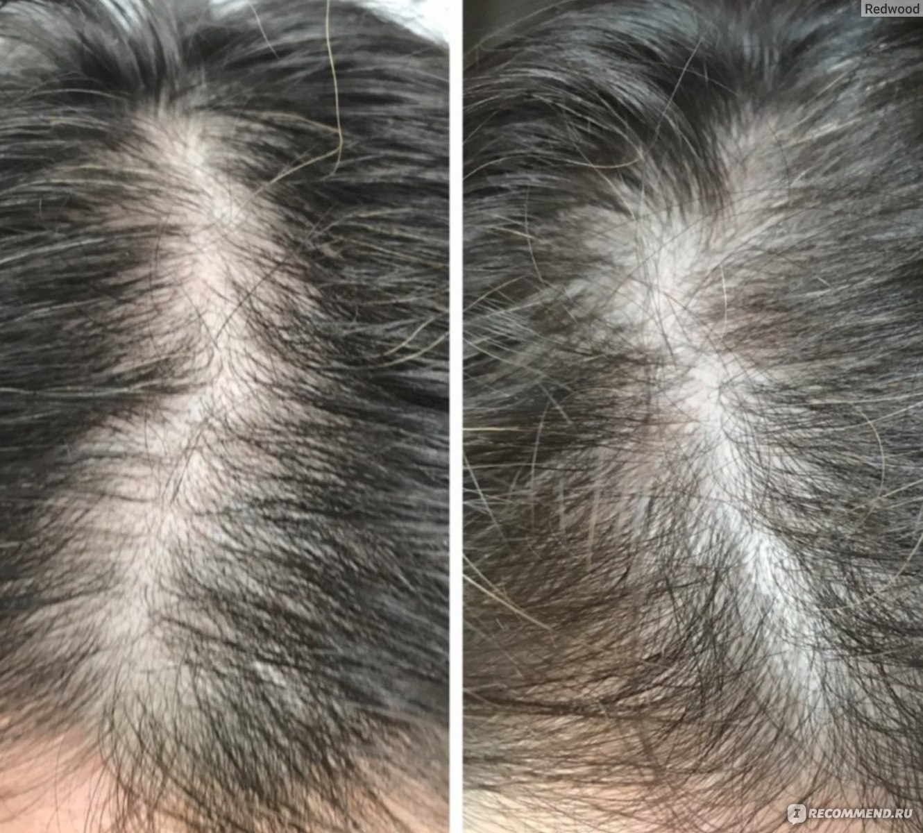 Никотиновая кислота для волос до и после фото мужчины