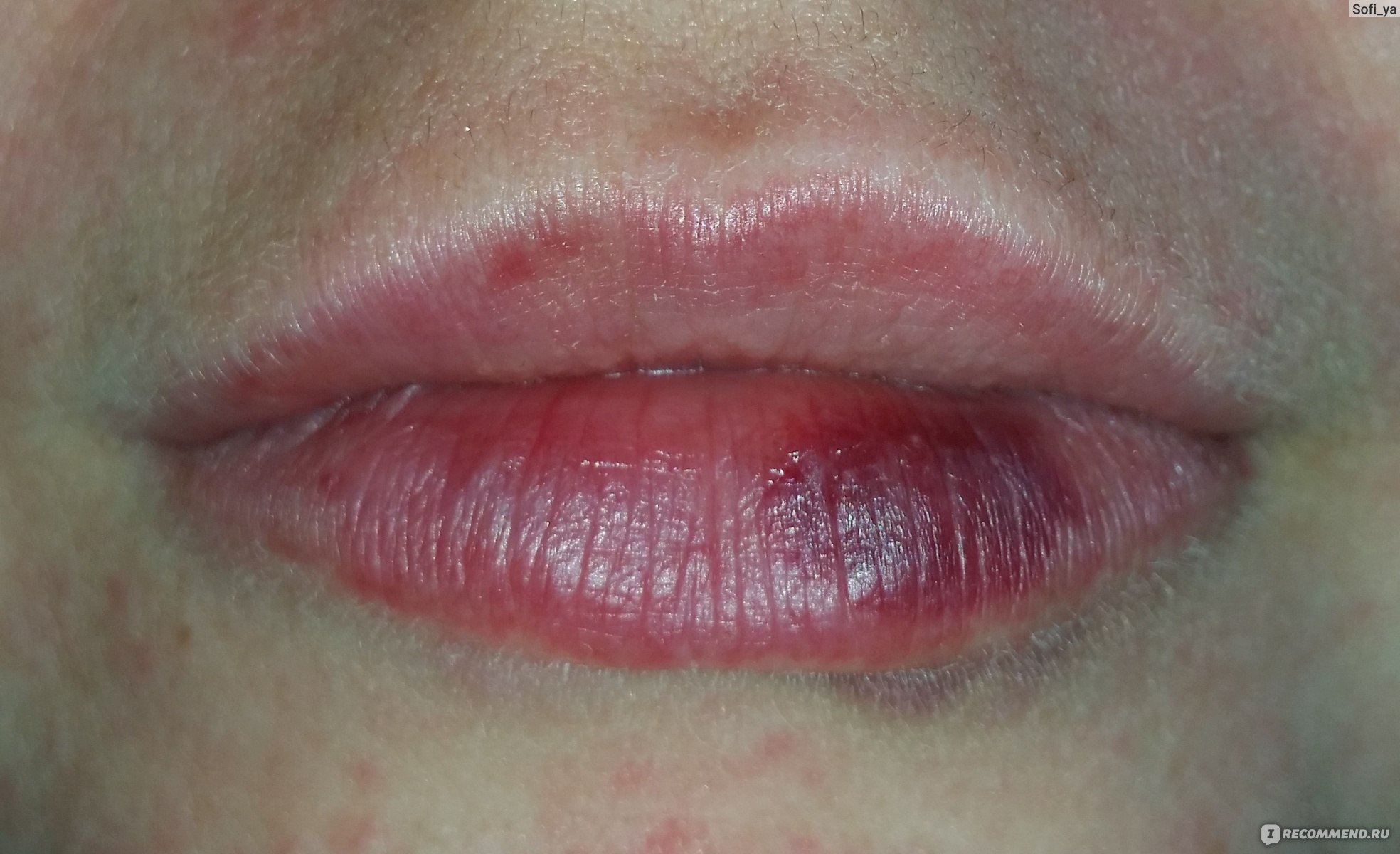 Лонгидаза для губ аллергия