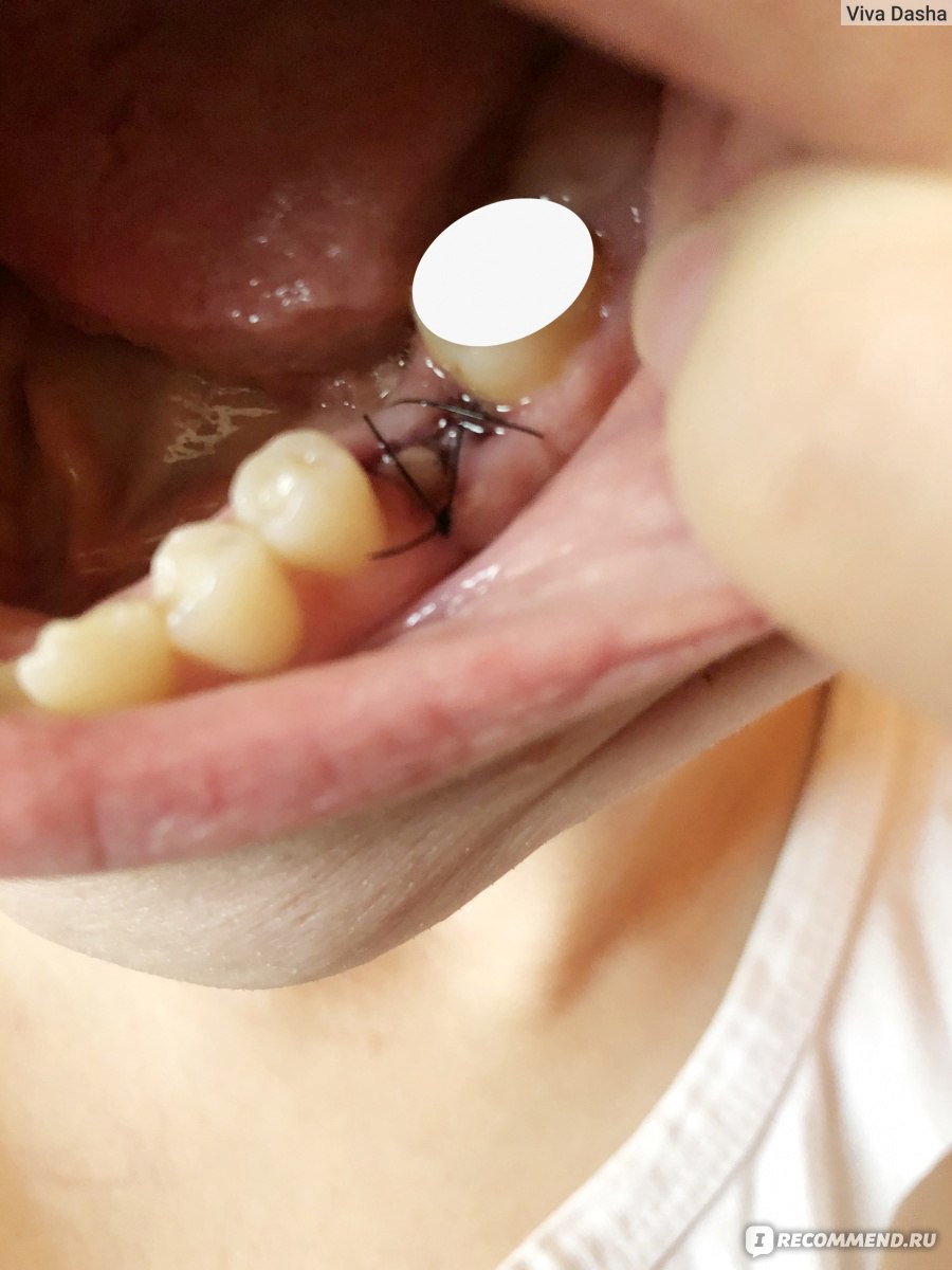 Швы после удаления зуба