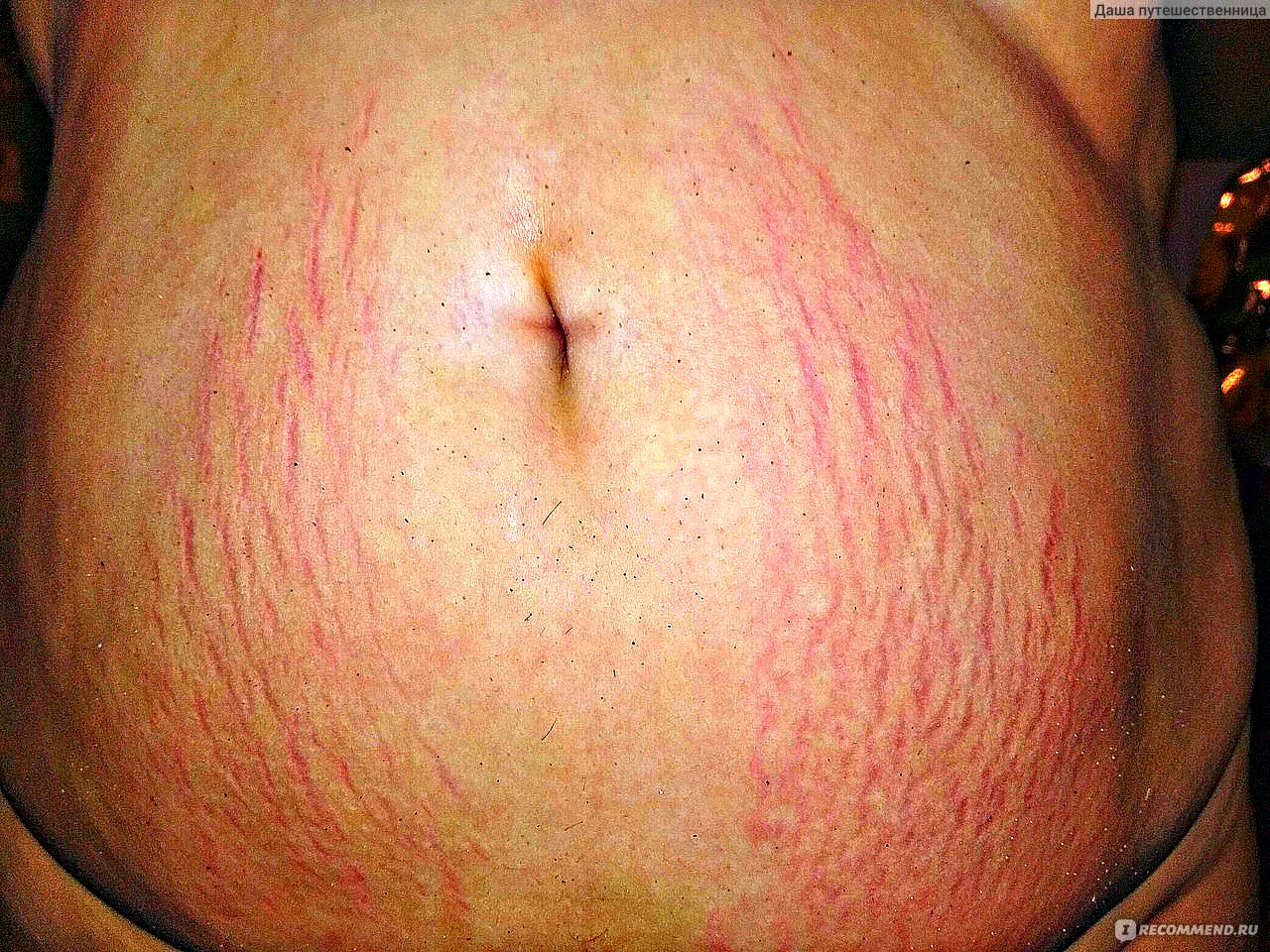 фото растяжек при беременности на груди фото 114