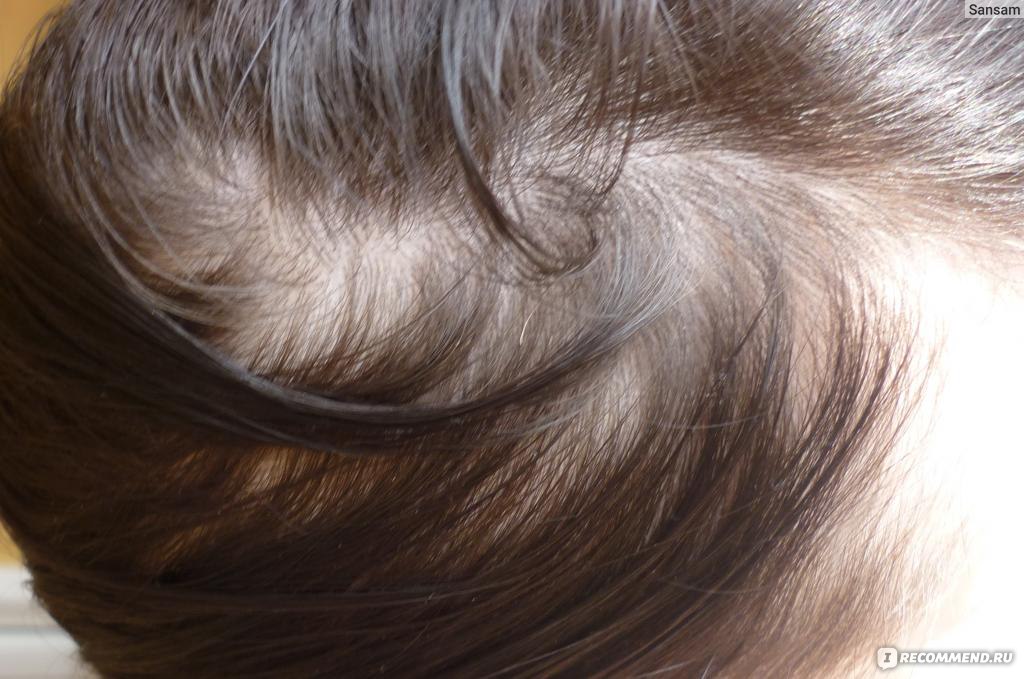 Как вы справились с выпадением волос после родов