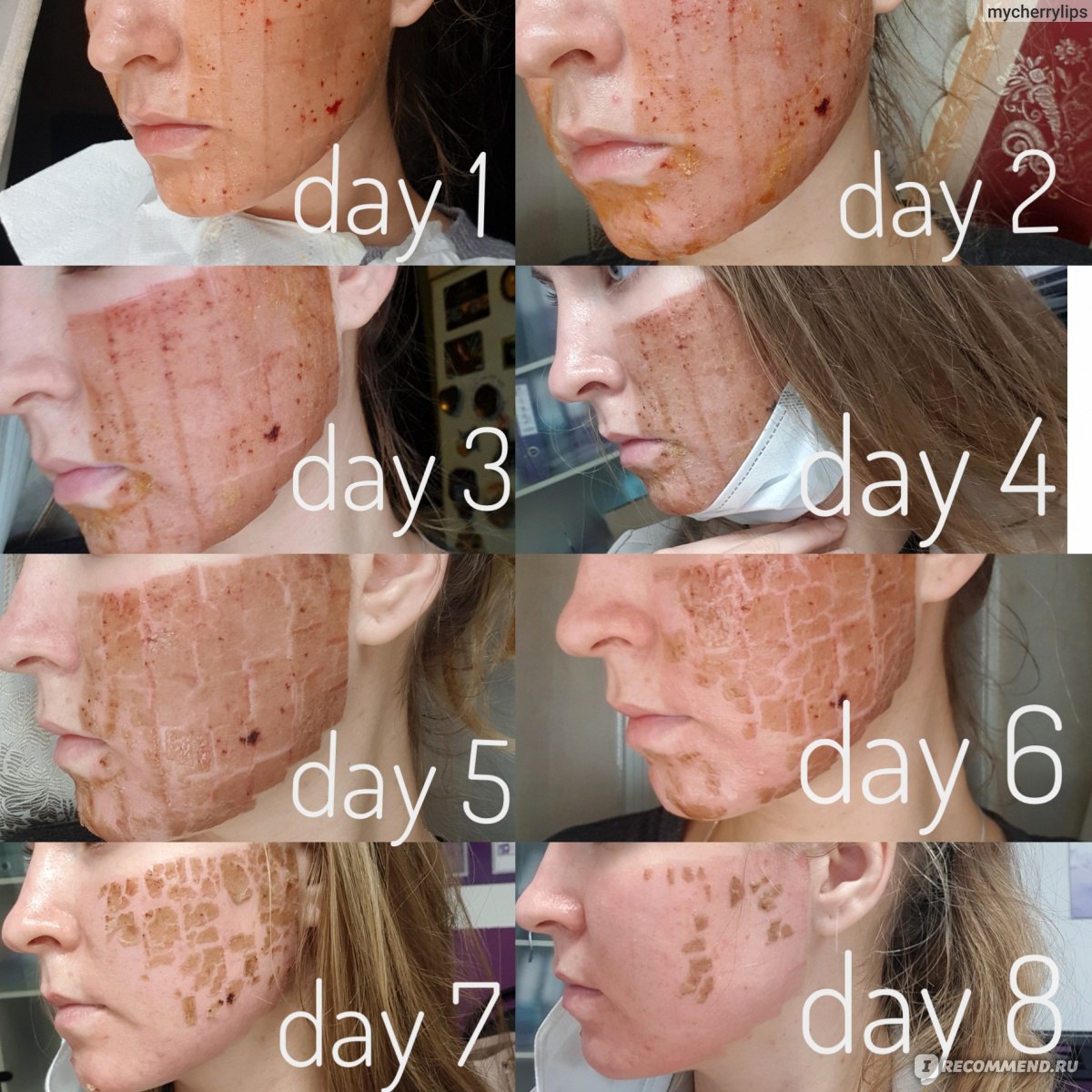 Лазерная шлифовка лица: стоимость, отзывы, фото до и после