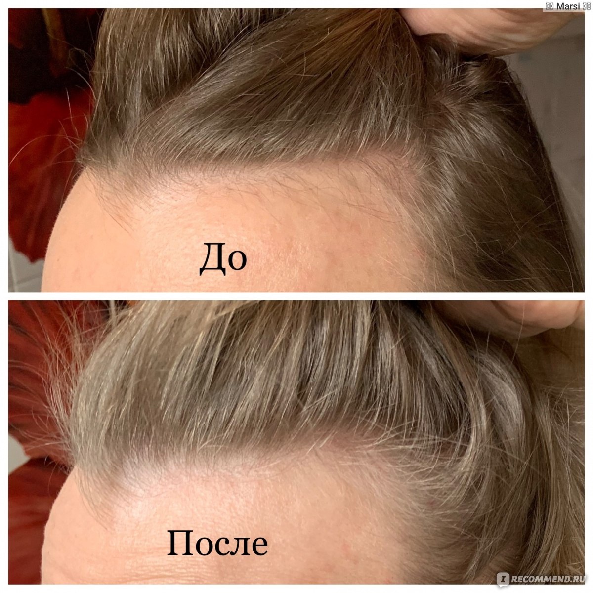 Никотиновая кислота для волос