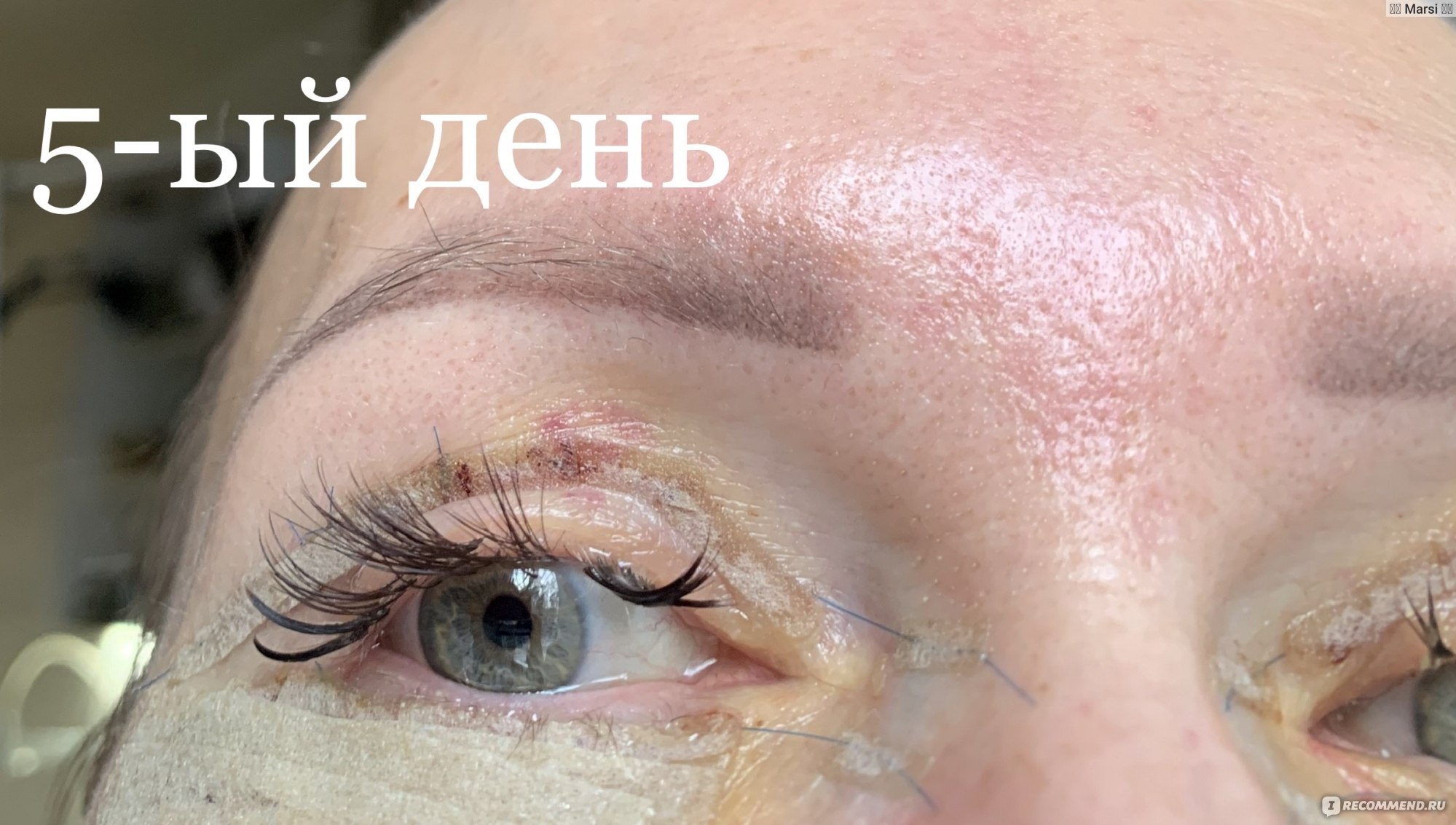 Features of rehabilitation after blepharoplasty