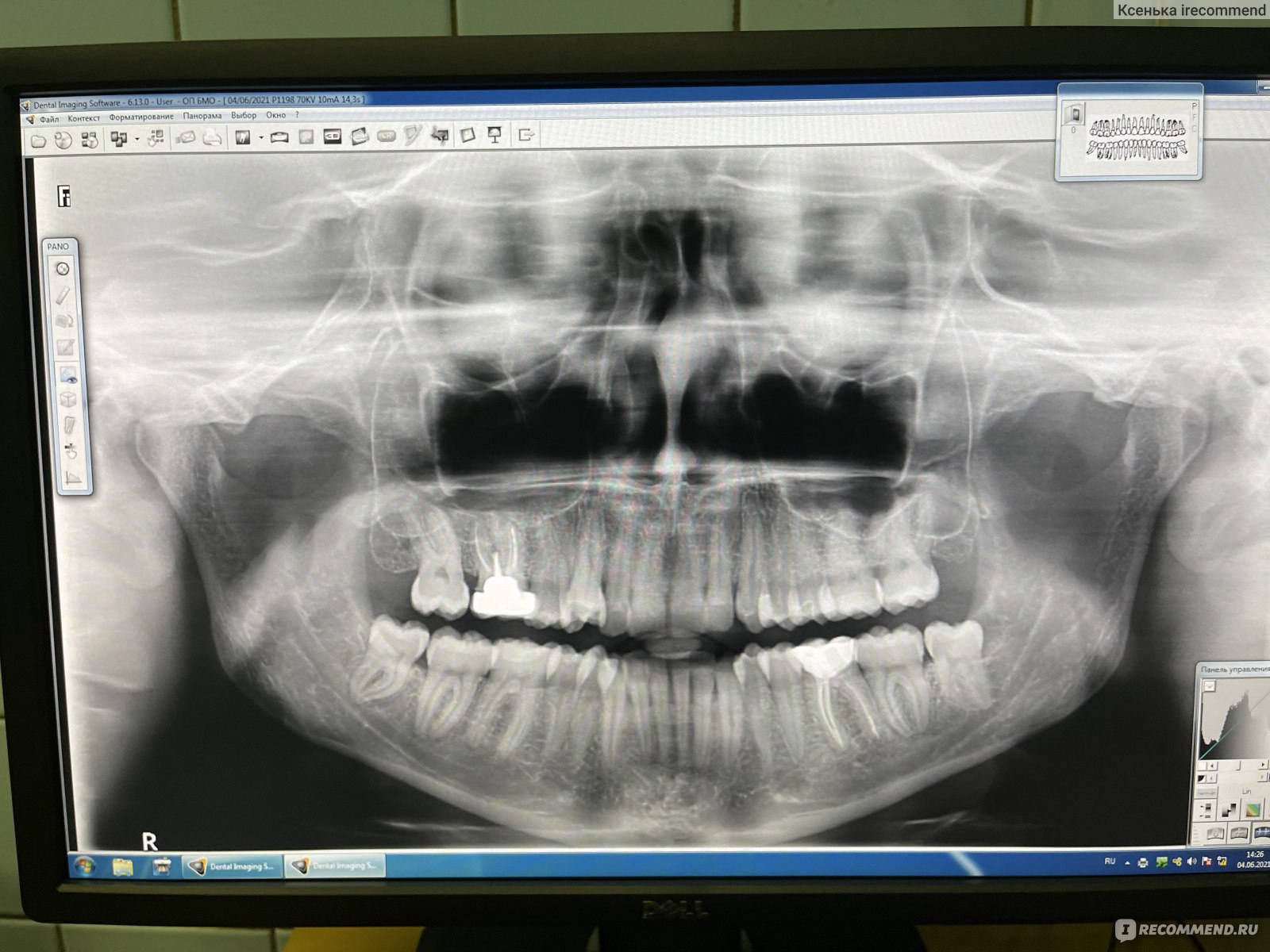 Ретинированный зуб мудрости рентген