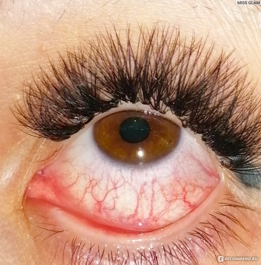Красные глаза после процедуры наращивания ресниц