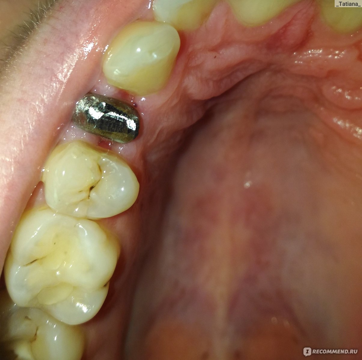 Зубные коронки из металлокерамики - «Подробный отзыв со всеми этапами  протезирования с культевой вкладкой... Много фото, не все для  слабонервных...» | отзывы