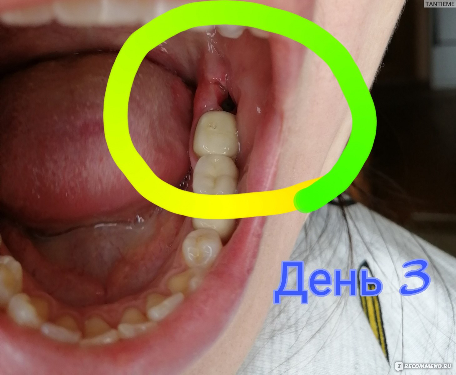 Сколько проходит анестезия зуба после лечения?