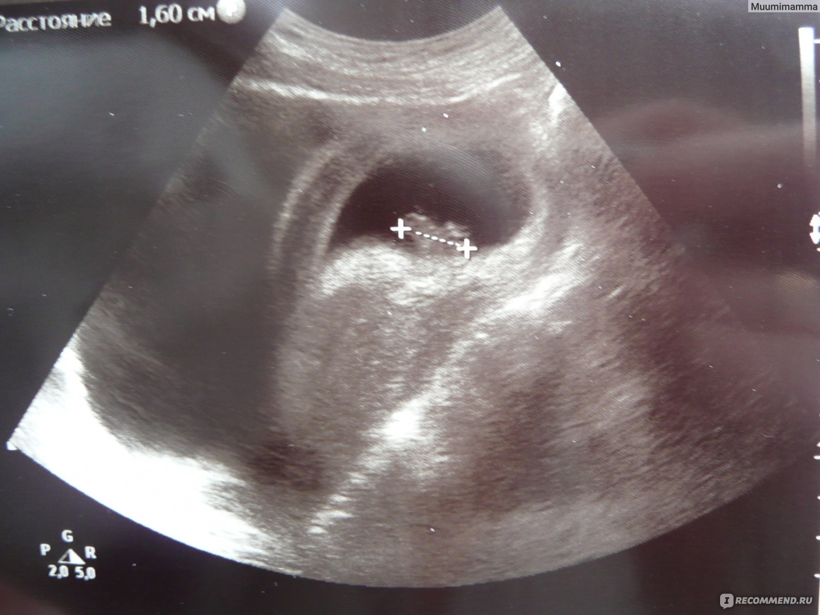 Эмбрион на 8 неделе беременности УЗИ