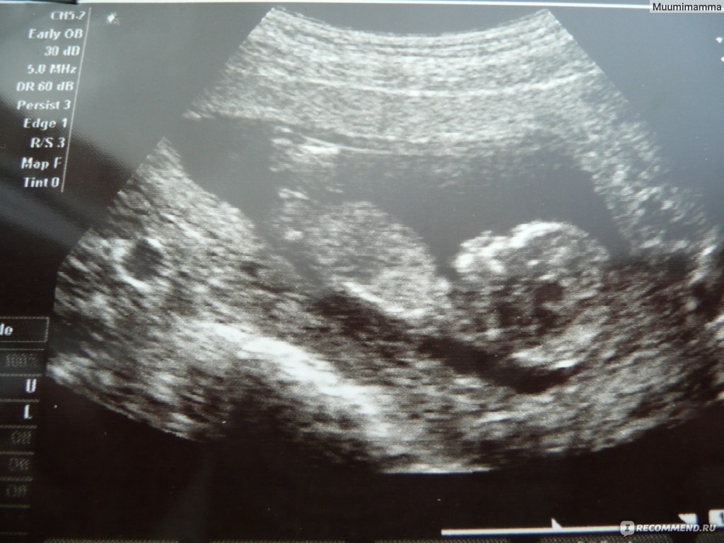 14 неделя 3 дня. УЗИ плода на 14 неделе беременности. Ребёнок на 14 неделе беременности УЗИ. 14 Недель беременности фото плода на УЗИ. 13 Недель беременности фото плода на УЗИ.