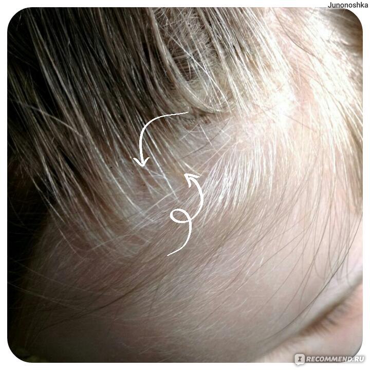 Если у ребенка при рождении клок седых волос