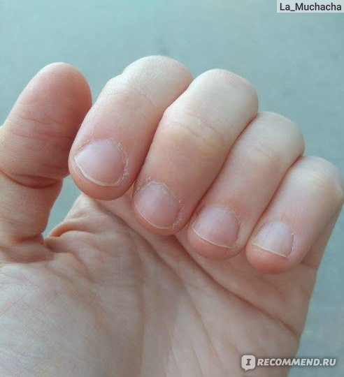 очень некрасивые ногти