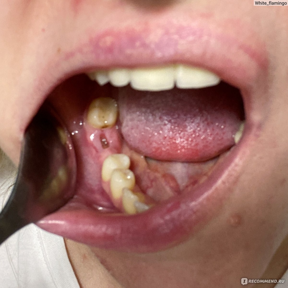 Сухая лунка после удаления зуба мудрости: причина появления, лечение | Colgate®