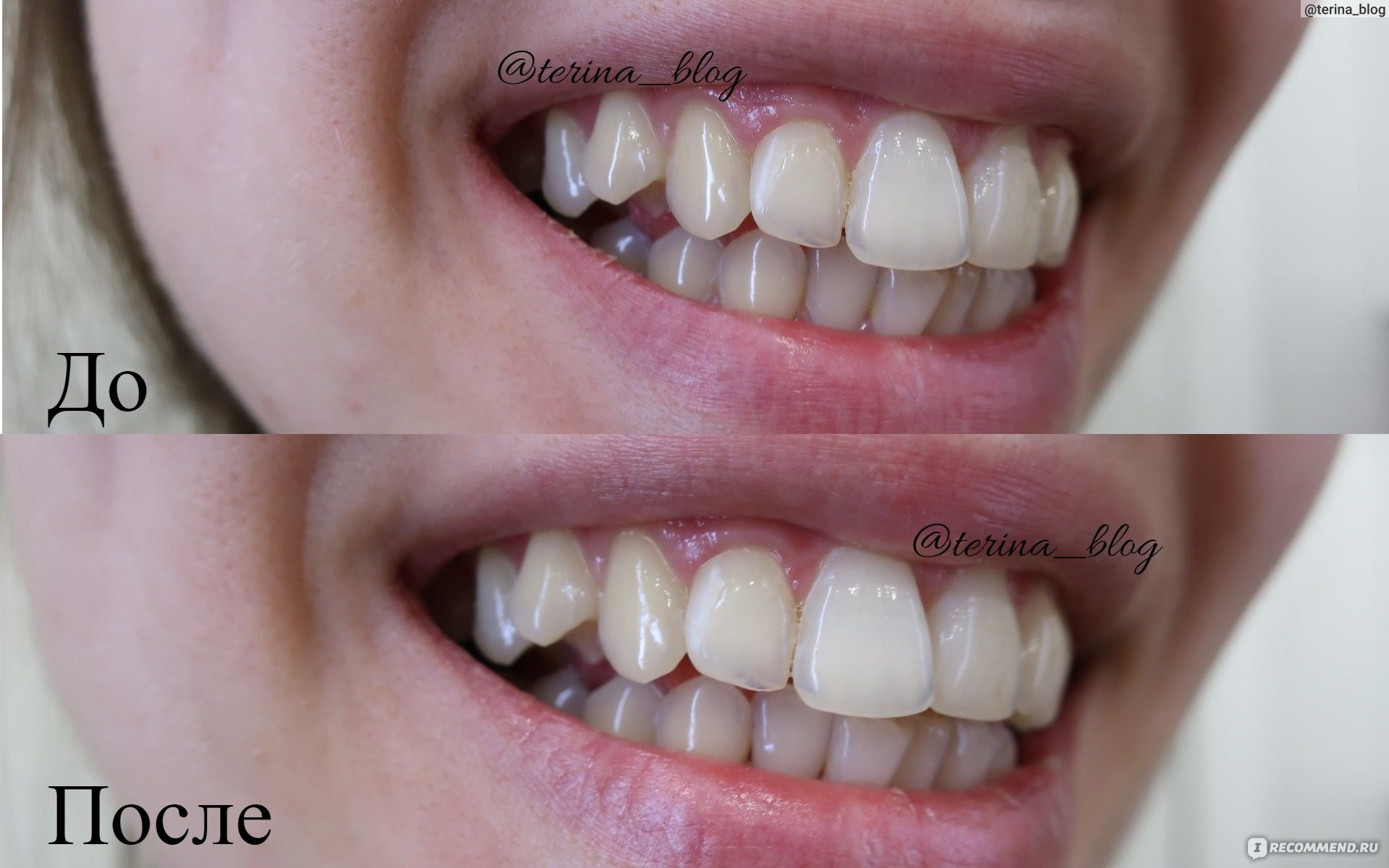 Профессиональная чистка зубов с Air-Flow. Фото «до» и «после»